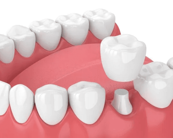 DENTAL CROWNS